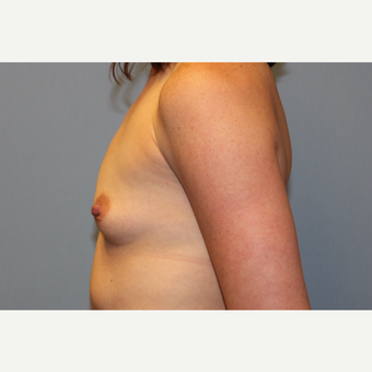 35-44 year old woman treated with Breast Augmentation before 3569724