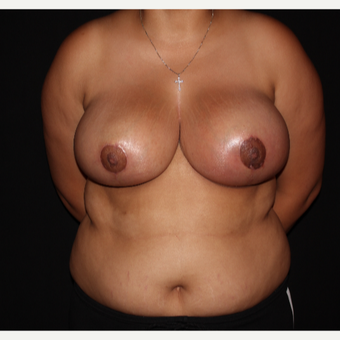 18-24 year old female treated with Traditional Breast Reduction after 3175869