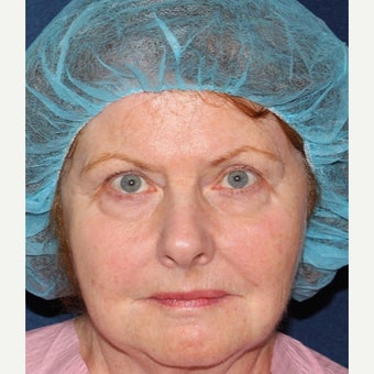 69 year old woman treated with IPL, Vbeam, and alexandrite after 1644209