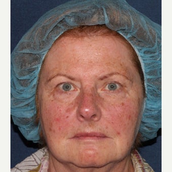 69 year old woman treated with IPL, Vbeam, and alexandrite before 1644209