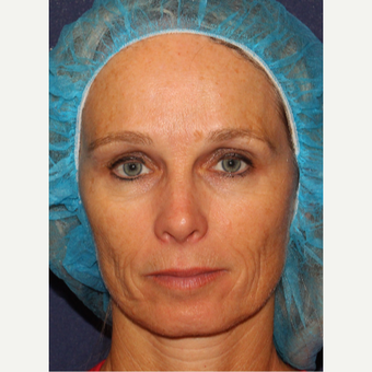 35-44 year old woman treated with Belotero before 3104664