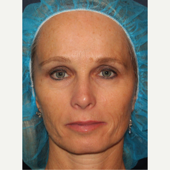 35-44 year old woman treated with Belotero after 3104664
