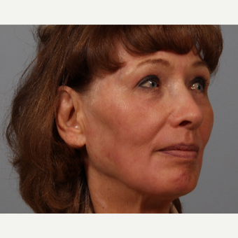70 year old woman, upper lid skin laxity, wrinkles. Treated with upper lid bleph, laser resurfacing. after 3419537
