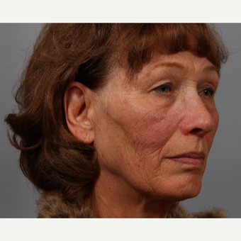70 year old woman, upper lid skin laxity, wrinkles. Treated with upper lid bleph, laser resurfacing. before 3419537