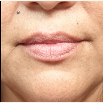 45-54 year old woman treated with Lip Augmentation before 3280198