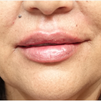 45-54 year old woman treated with Lip Augmentation after 3280198