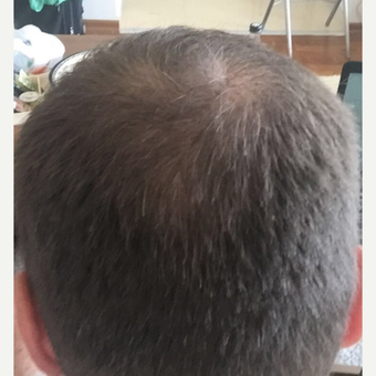 33 years old man treated with FUE Hair Transplant after 3068913