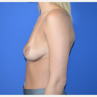 25-34 year old woman treated with Breast Augmentation before 3148390