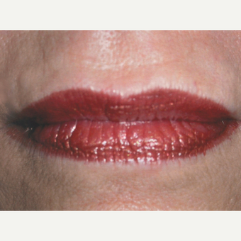 Dermabrasion after 3814125