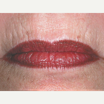 Dermabrasion before 3814125