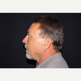 55-64 year old man treated with Direct Neck Lift after 3439255
