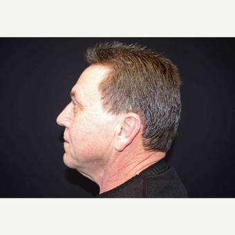 55-64 year old man treated with Direct Neck Lift before 3439255