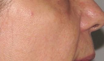 55 Year Old Female Treated for Age Spots after 1419379