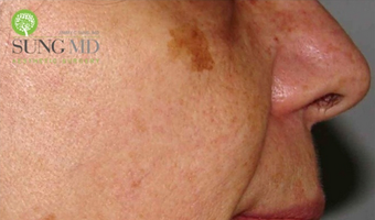 55 Year Old Female Treated for Age Spots before 1419379