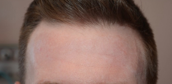 25-34 year old man treated with Chemical Peel after 1556994