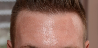 25-34 year old man treated with Chemical Peel before 1556994