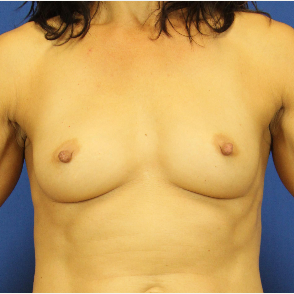 45-54 year old woman treated with Fat Transfer after 3748268