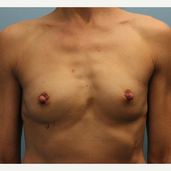 45-54 year old woman treated with Fat Transfer before 3748268