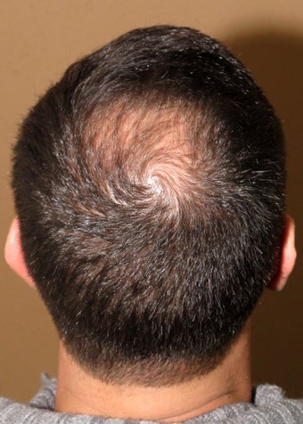 FUE hair transplantation - crown restoration no linear scars before 1100478