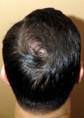 FUE hair transplantation - crown restoration no linear scars after 1100478