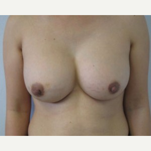 Breast Augmentation after 3054873