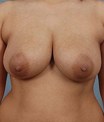 Breast Reduction before 481113
