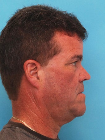 55-64 year old man treated with Orthognathic Surgery before 1712352