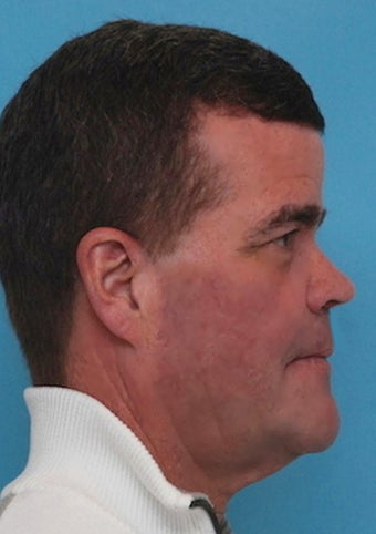 55-64 year old man treated with Orthognathic Surgery after 1712352