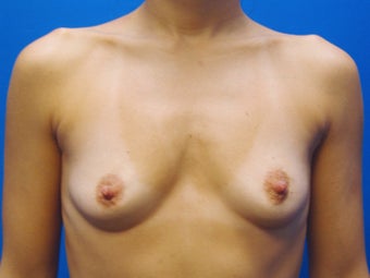 40 year old mother of two, three months after breast augmentation before 1411910