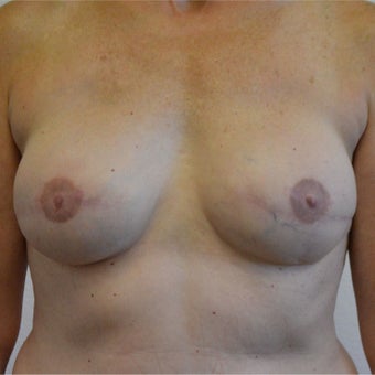 45-54 year old woman underwent Breast Reconstruction with Tissue Expanders followed by Implants after 1940755