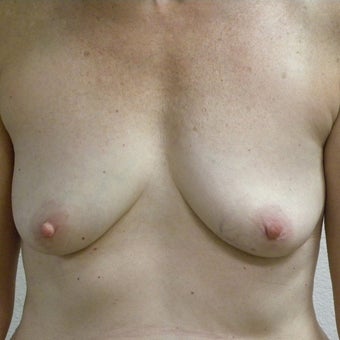 45-54 year old woman underwent Breast Reconstruction with Tissue Expanders followed by Implants before 1940755