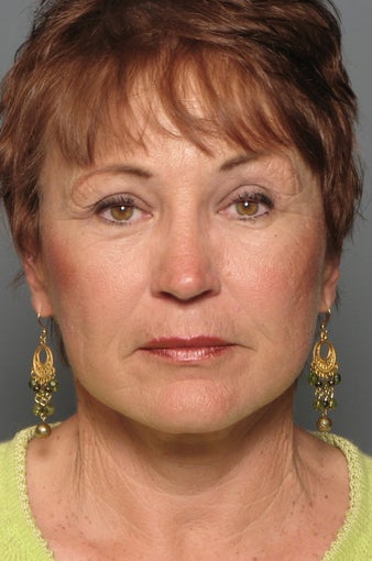 Brow Lift & Facelift after 338481