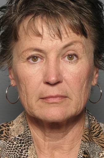 Brow Lift & Facelift before 338481