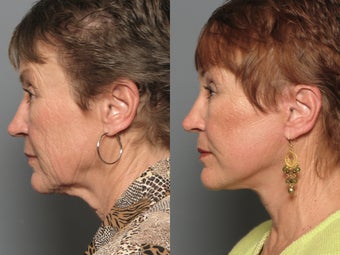 Brow Lift & Facelift 338481