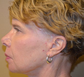 65-74 year old woman treated with Facelift and Lower Blepharoplasty 3371194