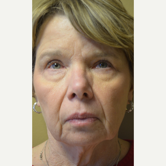 65-74 year old woman treated with Facelift and Lower Blepharoplasty before 3371194