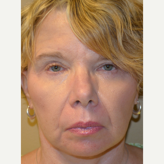 65-74 year old woman treated with Facelift and Lower Blepharoplasty after 3371194