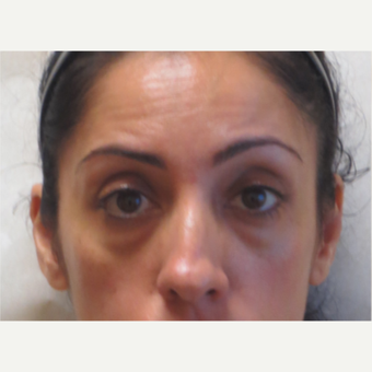 35-44 year old woman treated with Restylane under the eyes before 3381410