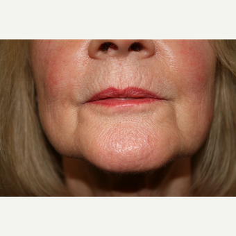 55-64 year old woman treated with Juvederm for her marionette lines before 3185464