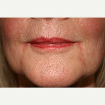 55-64 year old woman treated with Juvederm for her marionette lines after 3185464