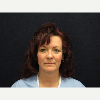 45-54 year old woman treated with Facelift before 3372258