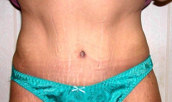 Abdominoplasty in Women after 1218932