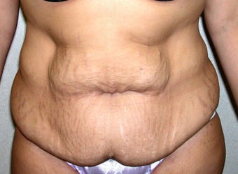 Abdominoplasty in Women before 1218932