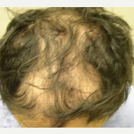 35 year old man treated with FUE Hair Transplant before 3724516