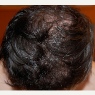 35 year old man treated with FUE Hair Transplant after 3724516