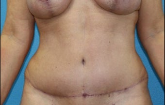 45-54 year old woman treated with Tummy Tuck after 3203788