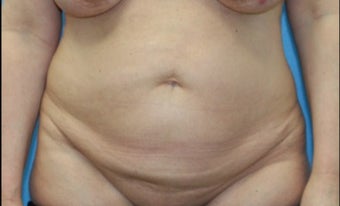 45-54 year old woman treated with Tummy Tuck before 3203788