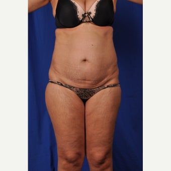 52 year-old woman desired a mini tummy tuck with liposuction before 2381040