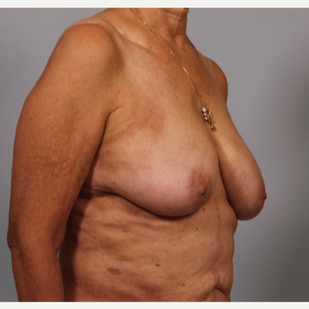 58 year old woman with somewhat large breasts, poor shape. Treated with breast reshaping. before 3420111
