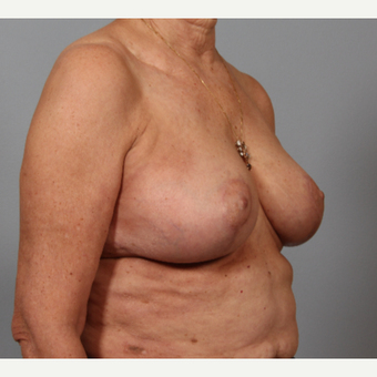 58 year old woman with somewhat large breasts, poor shape. Treated with breast reshaping. after 3420111